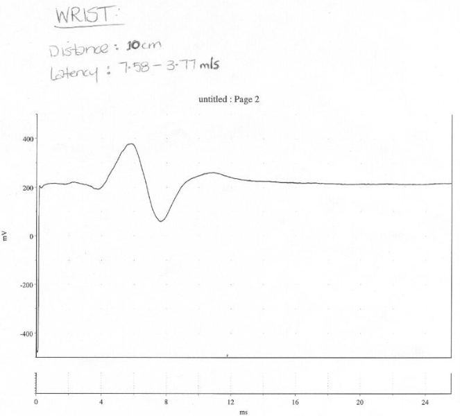 A graph showing the relationship between the latency and current used in the measurement of wrist nerve conduction.