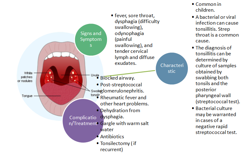 A figure showing a mind map of tonsillitis.