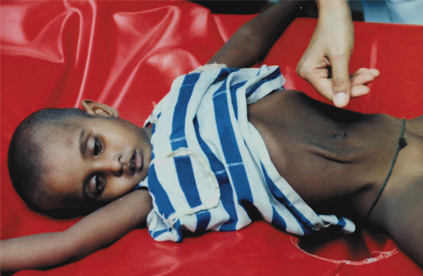 A child, lying on a cholera cot, showing typical signs of severe dehydration from cholera