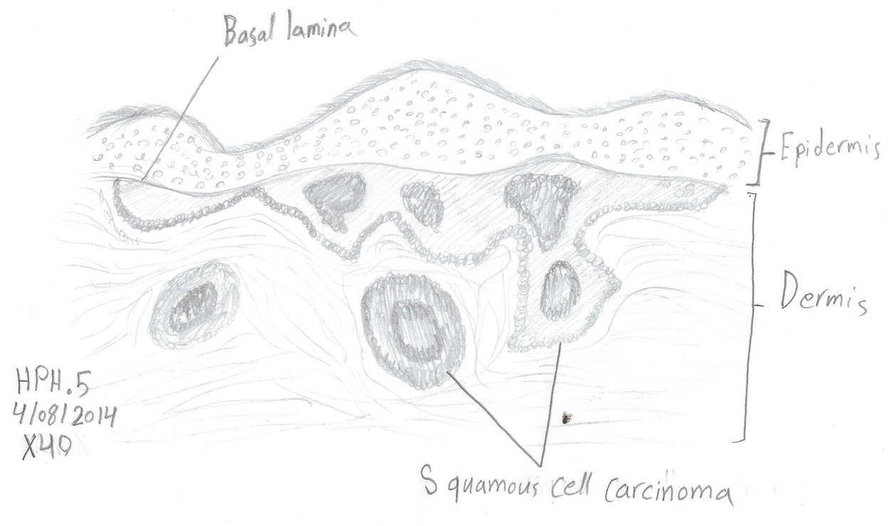 A traverse section of squamous cell carcinoma in human skin at a magnification of ×40.