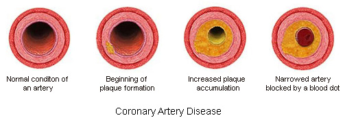 Coronary Artery Disease: Normal Physiology and Pathology