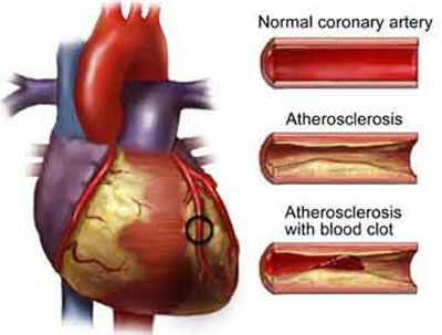 Coronary Artery Disease: Normal Physiology and Pathology