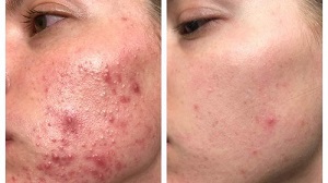A woman shares before and after photos after using a "specially formulated" moisturizer 