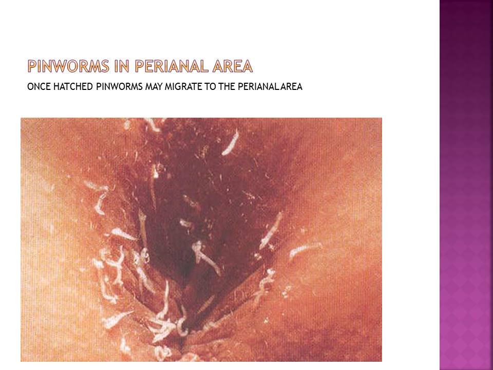 Pinworms in perianal area. Once hatched pinworms May migrate to the perianal area 