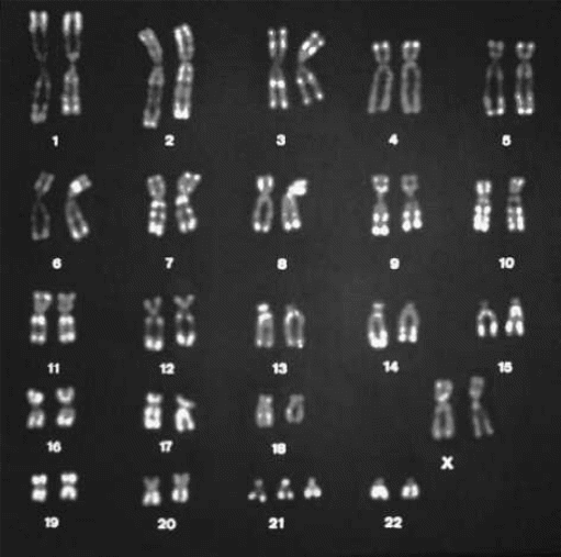 Genetic map with three copies of chromosome 21