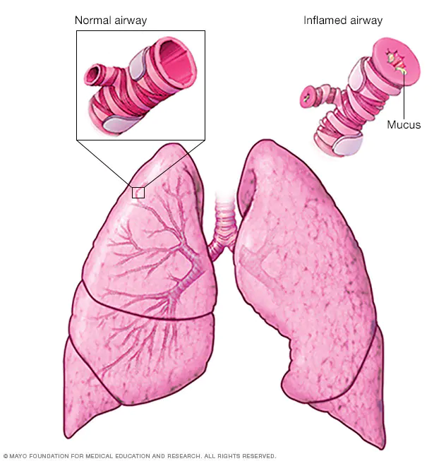 Comparison of normal airways and those affected by asthma 