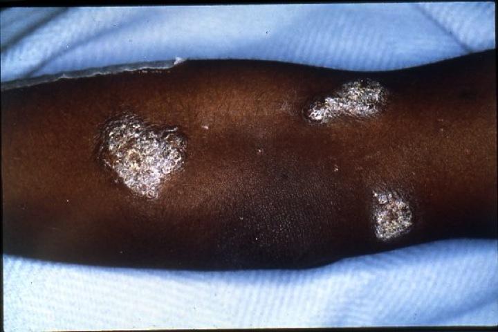 Picture 2. Skin Lesions of Blastomycosis
