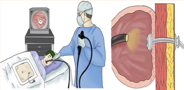 Endoscopic G-Tube Placement