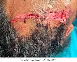 An avulsion wound on the head