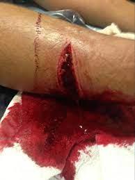 A laceration wound on the ankle