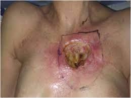 A radiation wound on the chest