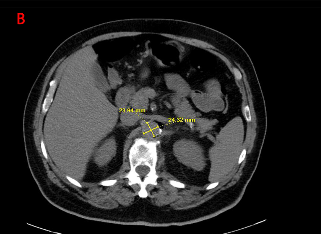 Mid Abdominal Aortitis Framed by Yellow Measurements