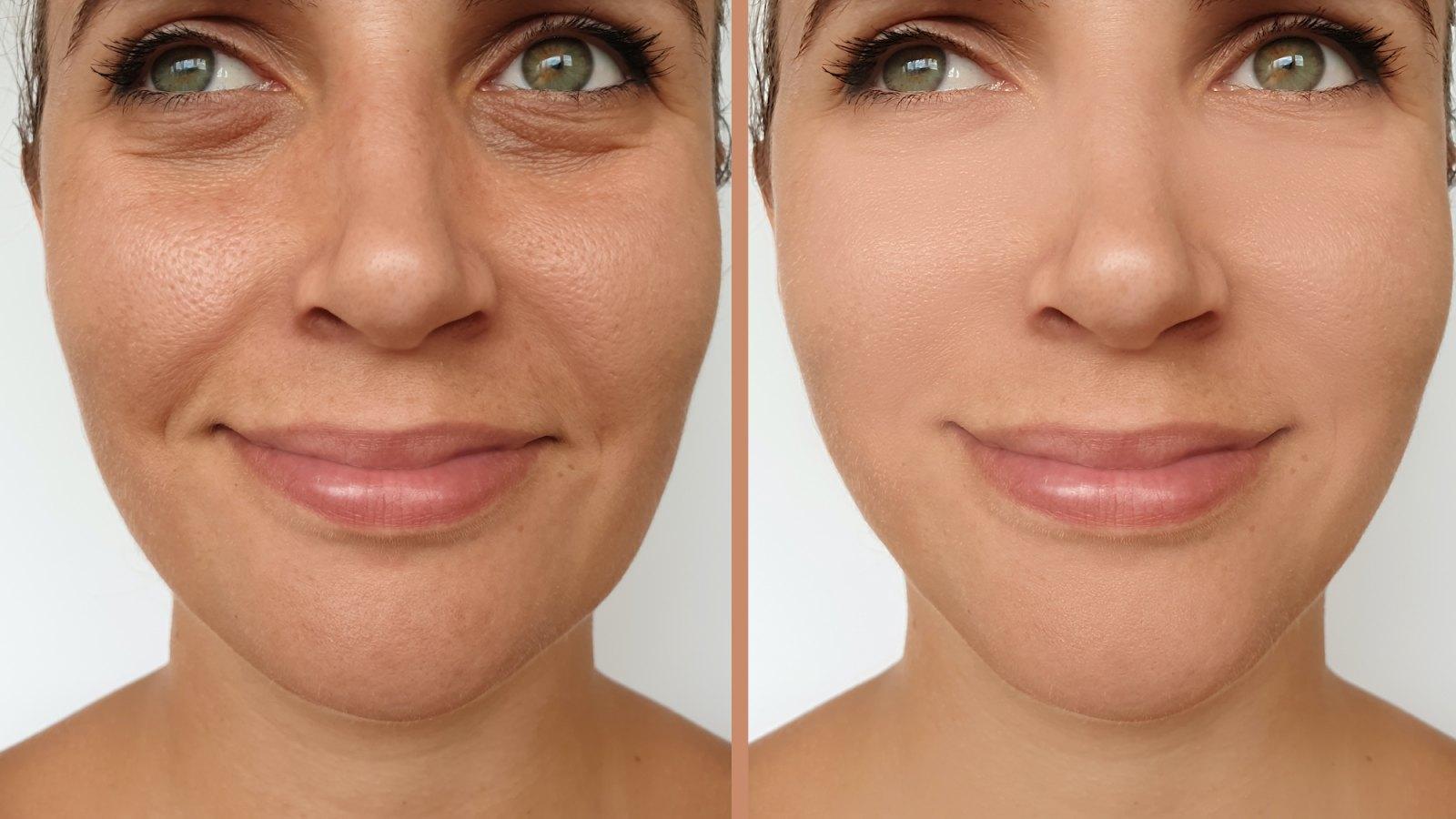 Before and After Skincare
