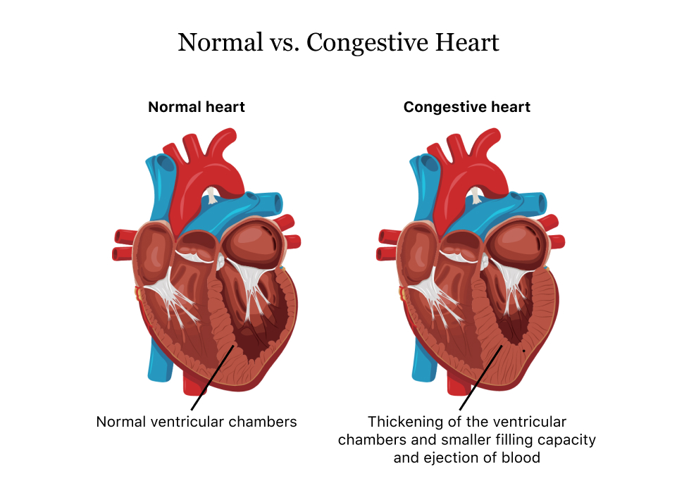 A congestive heart diagram
