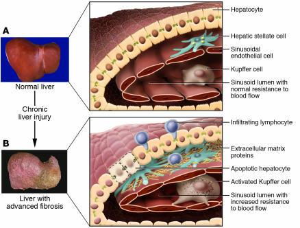 The difference between a normal liver and a liver with advanced fibrosis