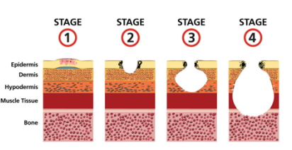 Stages of pressure injuries
