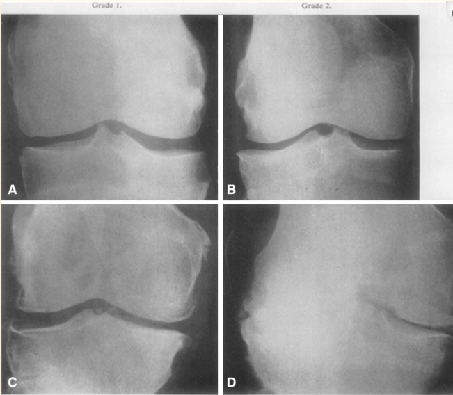 Classifications in brief: Kellgren-Lawrence classification of osteoarthritis