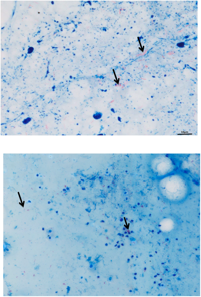 Mycobacterium tuberculosis under the microscope.