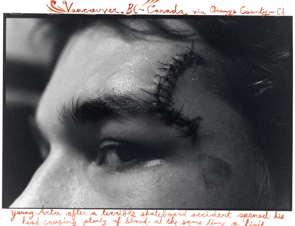 Arto with scar photographed by Ed Templeton.