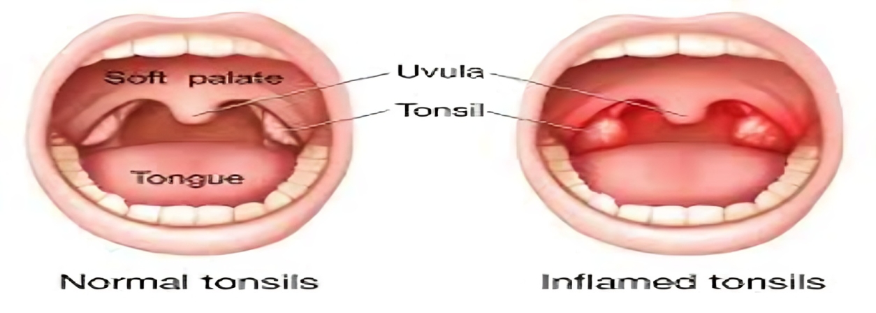 Appearance of Normal vs. Inflamed Tonsils.
