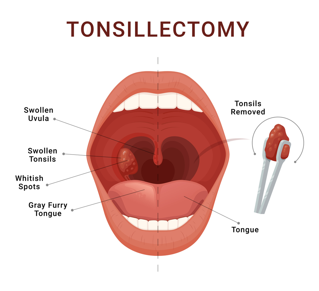 Tonsillectomy.