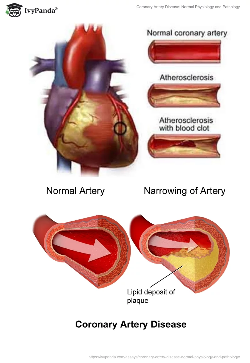 Coronary Artery Disease: Normal Physiology and Pathology. Page 4