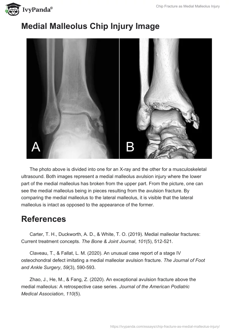Chip Fracture as Medial Malleolus Injury. Page 3
