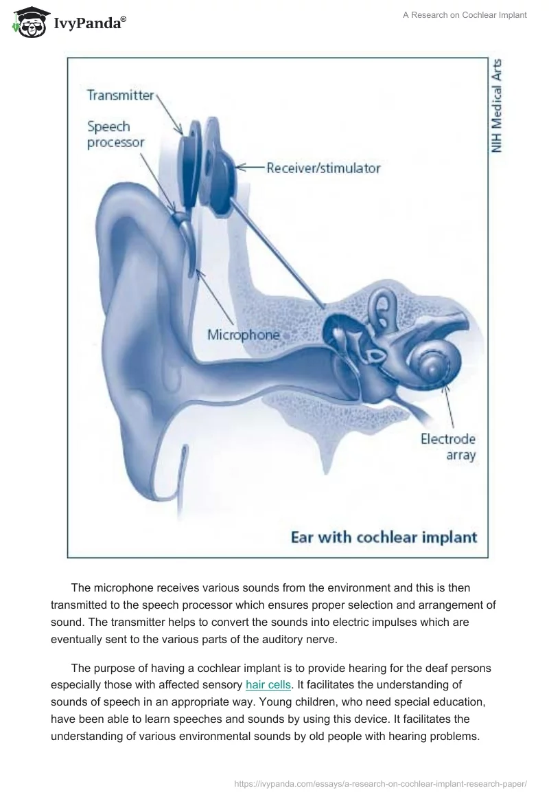 A Research on Cochlear Implant. Page 2